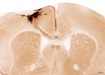 Alimlər insult zədələnməsini kök hüceyrələrlə bərpa etdilər